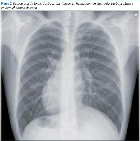 Figura 2. Radiografía de tórax: dextrocardia, hígado en hemiabdomen izquierdo, burbuja gástrica
en hemiabdomen derecho.